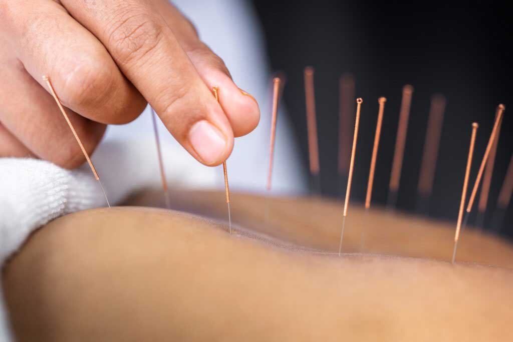 Acupuncture may help lower back, neck, shoulder pain migraines 